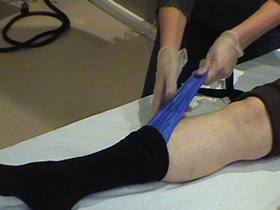 En person med gips på benet på en säng.
